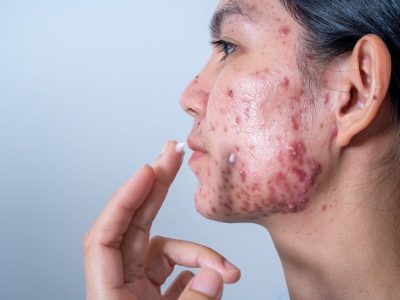 Cystic Acne Atau Jerawat Batu Pada Wajah